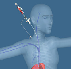 ביופסית כבד טראנסג'וג'ולר - Transjugular Liver Biopsy